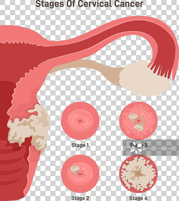 宫颈癌恶性肿瘤起源于图片素材