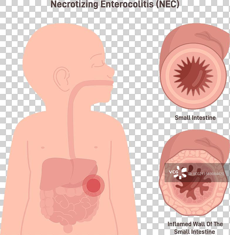 坏死性小肠结肠炎或坏死性疾病图片素材