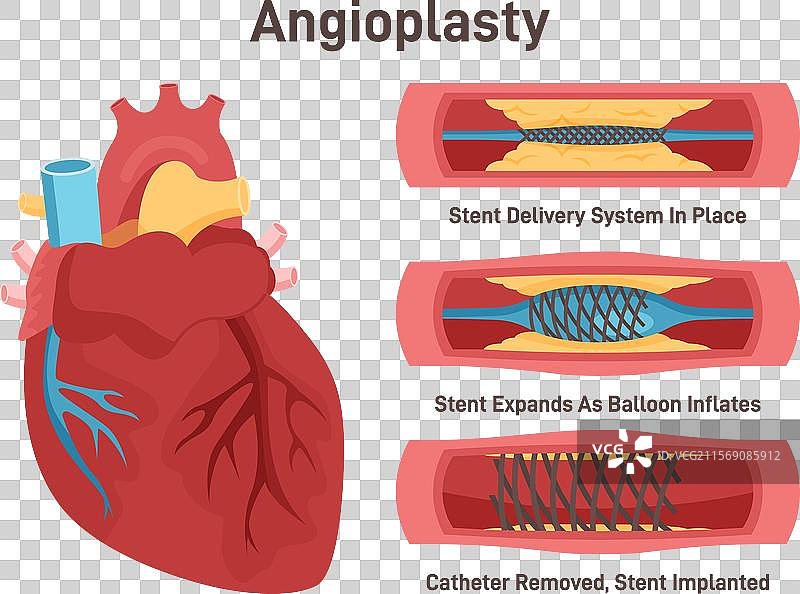 血管成形术支架的输送与植入图片素材