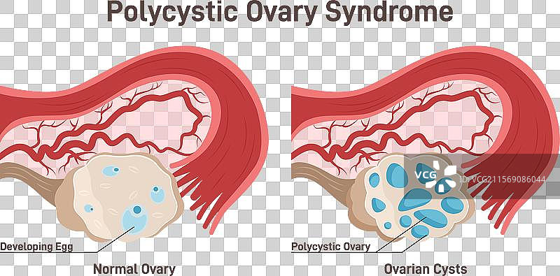 多囊卵巢综合症（PCOS）激素疾病图片素材