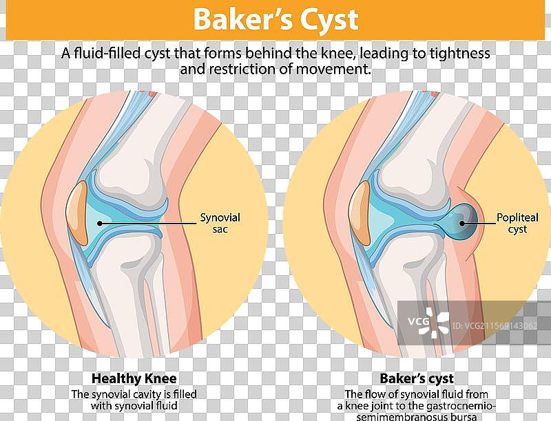 健康膝关节与贝克氏囊肿的比较图片素材