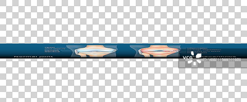 骨关节炎 关节炎 退行性关节病图片素材