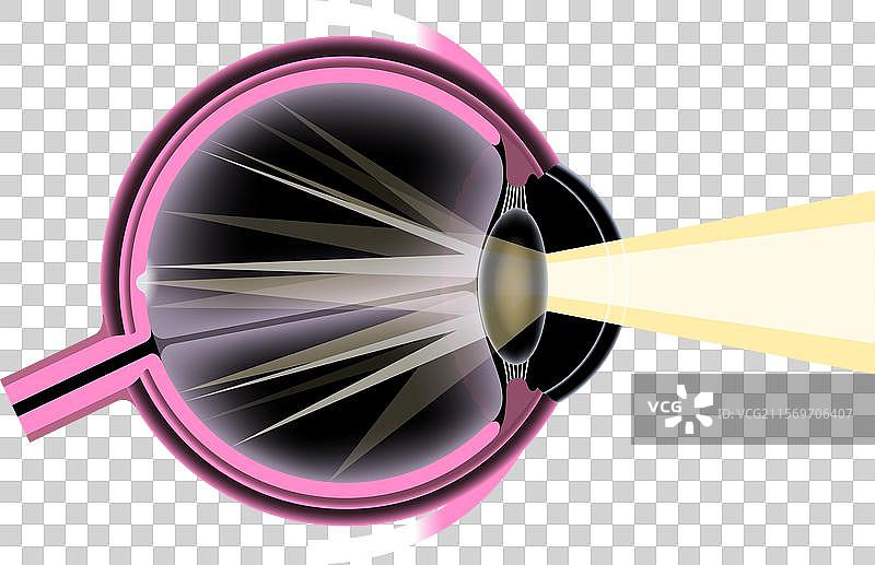 白内障眼病图片素材