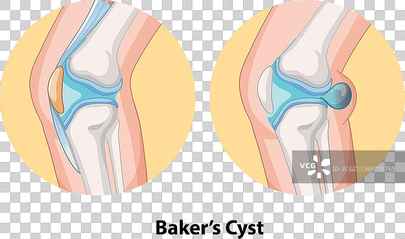 膝关节的贝克囊肿图片素材