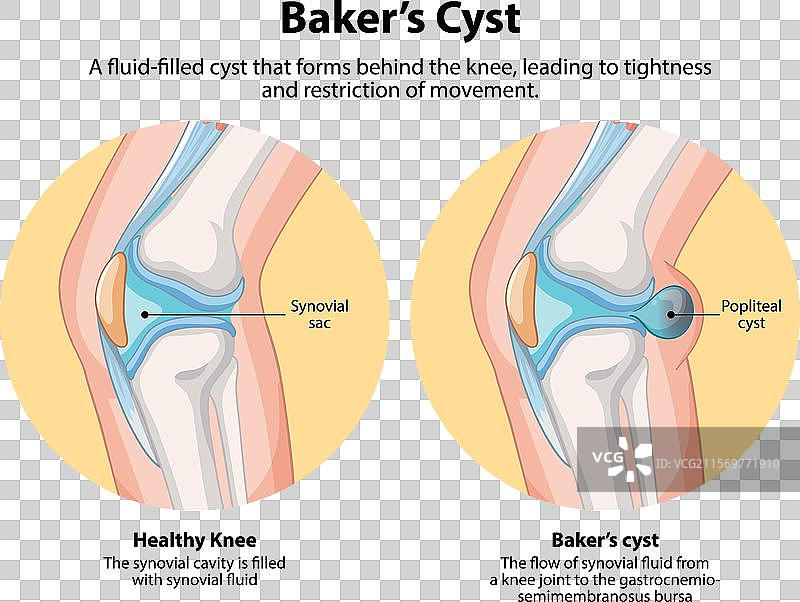 健康膝关节与贝克氏囊肿的比较图片素材