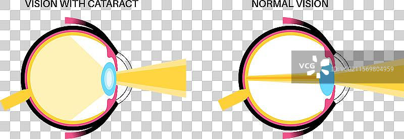 白内障眼病图片素材