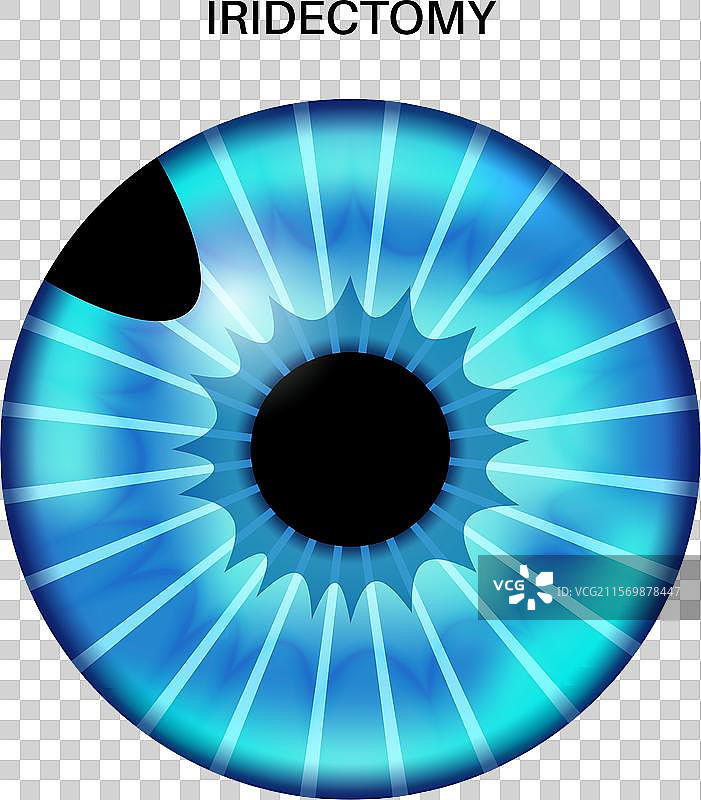 虹膜黑色素瘤解剖学图片素材