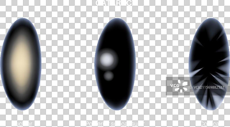 白内障眼病图片素材