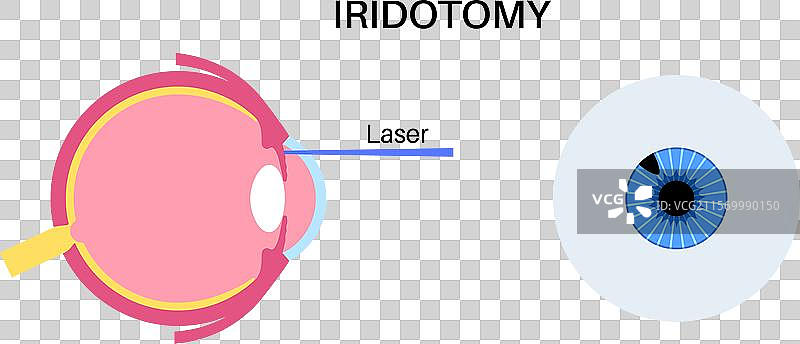虹膜切除术医学海报图片素材