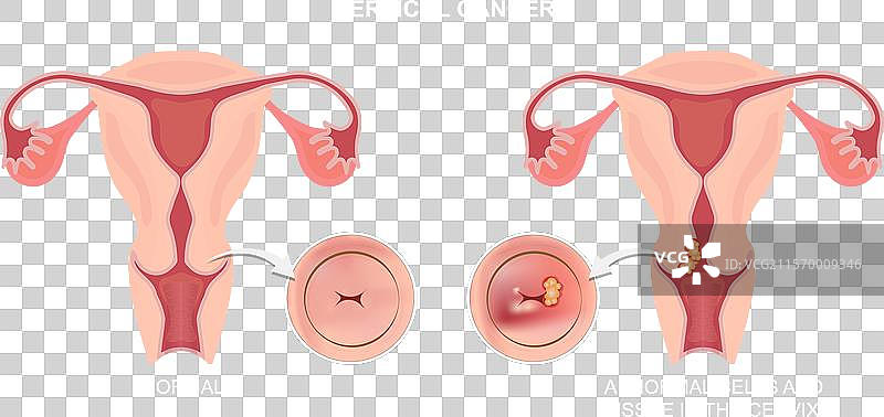 宫颈癌是细胞的生长，起始于图片素材
