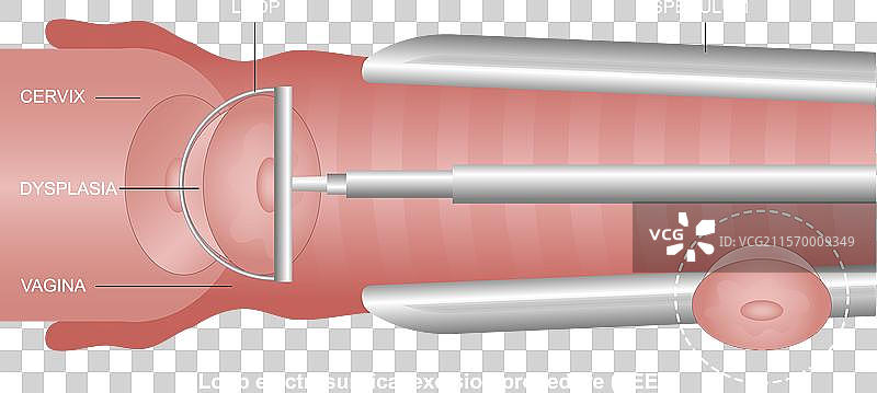 LEEP环形电外科切除术图片素材