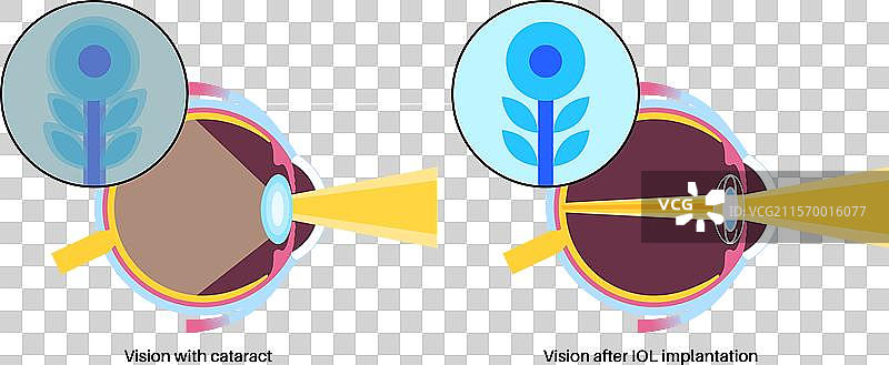 眼内镜海报图片素材