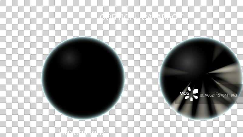 白内障眼病图片素材