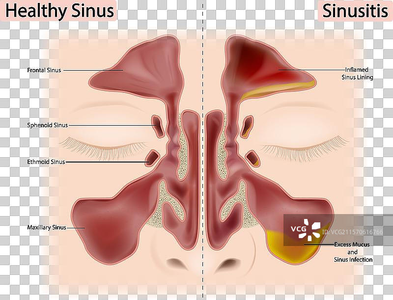 健康的鼻窦和鼻窦炎或鼻窦鼻炎图片素材