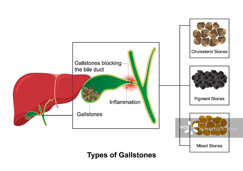 胆结石主要有三种类型。图片素材