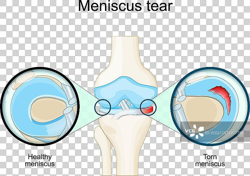膝关节半月板撕裂的解剖特写图片素材