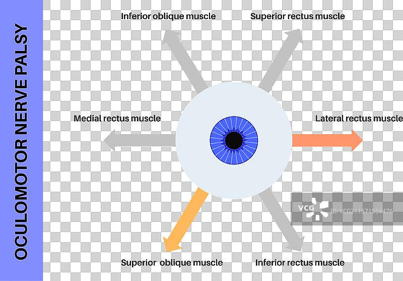 动眼神经麻痹图片素材