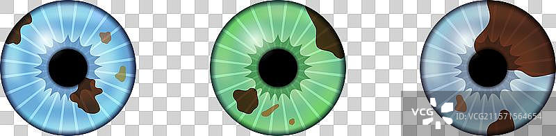 虹膜黑色素瘤解剖学图片素材