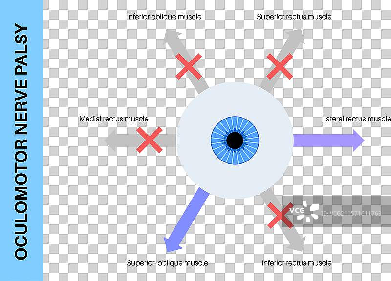 动眼神经麻痹图片素材
