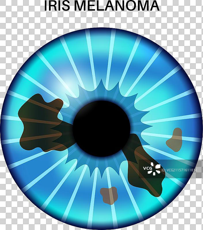 虹膜黑色素瘤解剖学图片素材