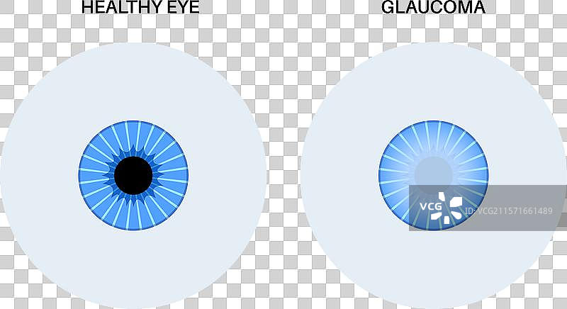 青光眼眼病图片素材