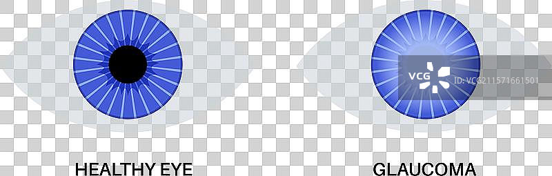 青光眼眼病图片素材