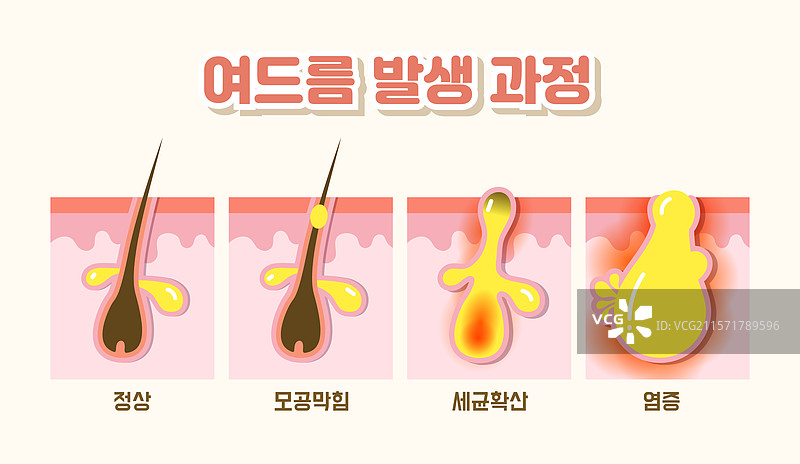 人类皮肤，护肤，皮肤科，痤疮，毛囊，毛孔，炎症，脓性图片素材