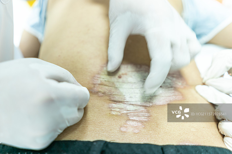 中国中医药服务拍摄主题，中医医院医生正在给病人患者后背火疗针灸拔罐，室内无人图像摄影图片素材