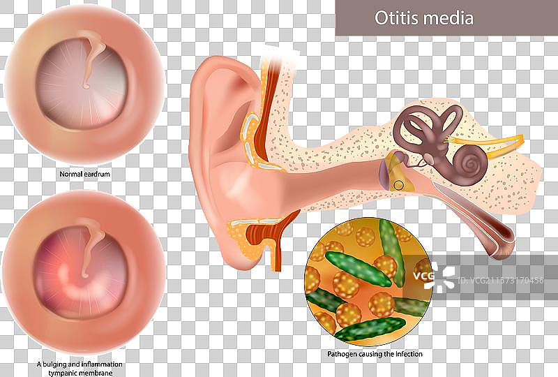 中耳炎或慢性化脓性病原体图片素材