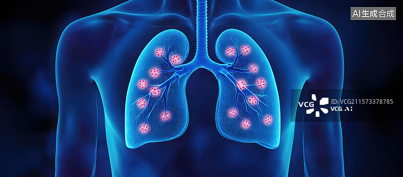 【AI数字艺术】肺部感染的医学影像图片素材