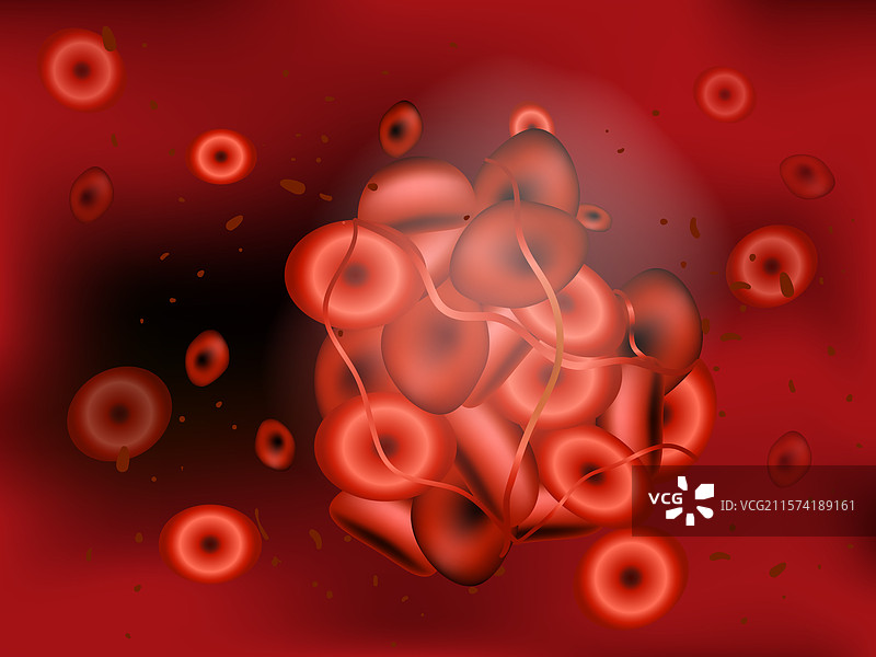 栓子描绘栓塞情况图片素材
