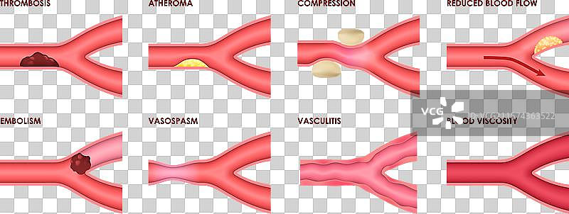 静脉疾病：血栓、动脉粥样硬化和血管炎图片素材