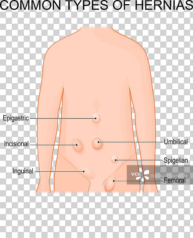 疝气类型及常见疝气部位图片素材