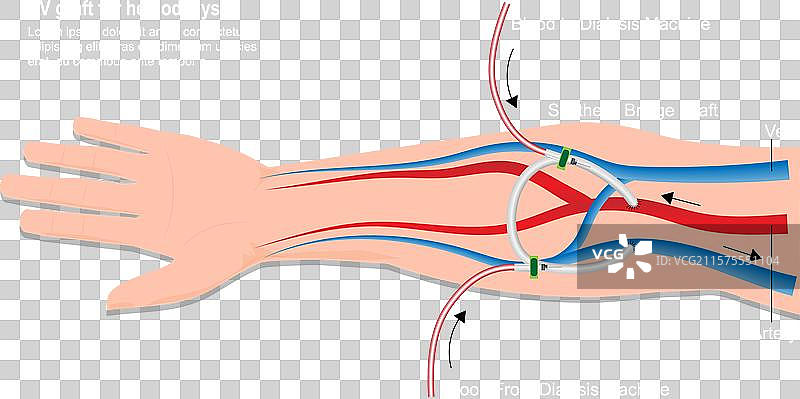动静脉（AV）移植物是一种通路类型。图片素材