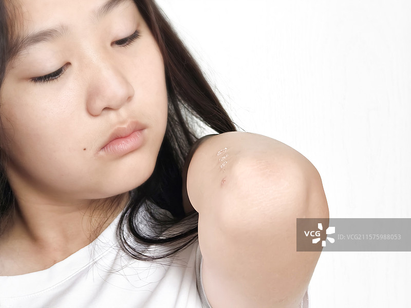 女孩胳膊皮肤干燥起红疹图片素材