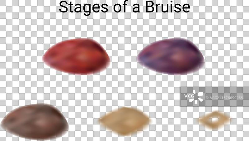 瘀伤和血肿的愈合阶段图片素材