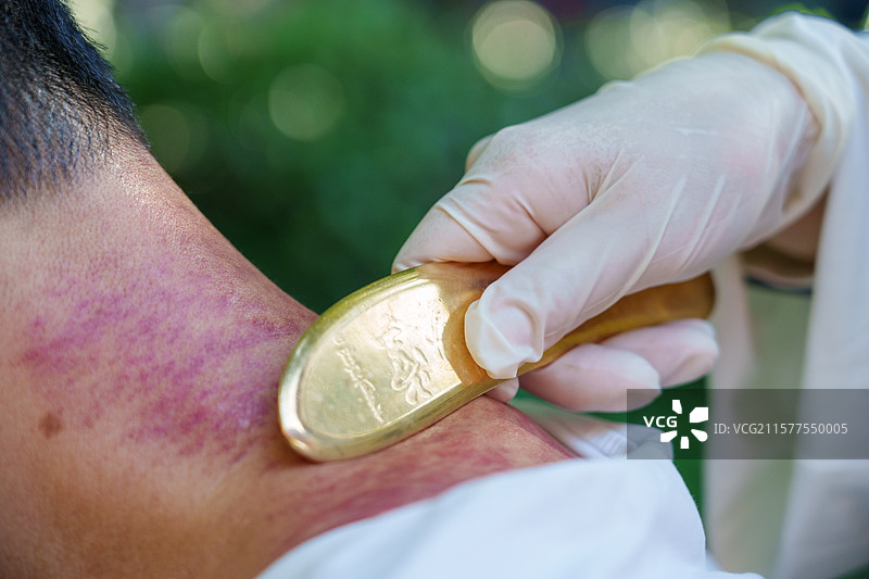 中医 刮痧 传统文化 医生手持刮痧板对患者颈部刮痧图片素材