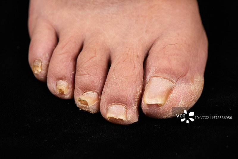 老年人脚趾灰指甲甲癣特写图片素材