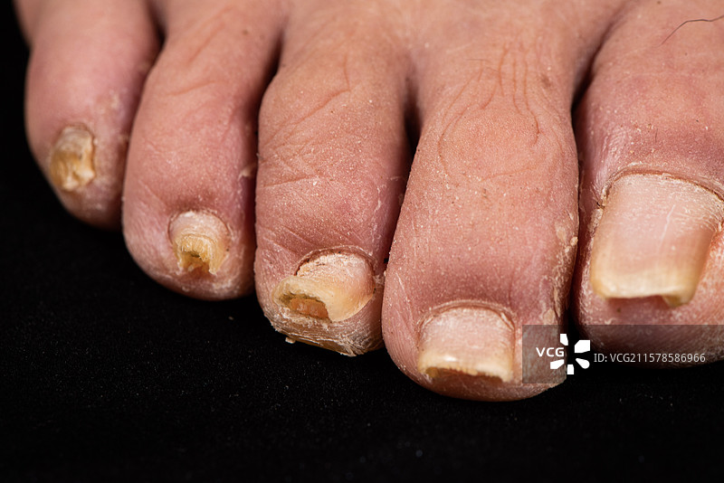 老年人脚趾灰指甲甲癣特写图片素材