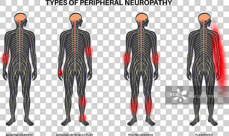 周边神经病医学海报图片素材