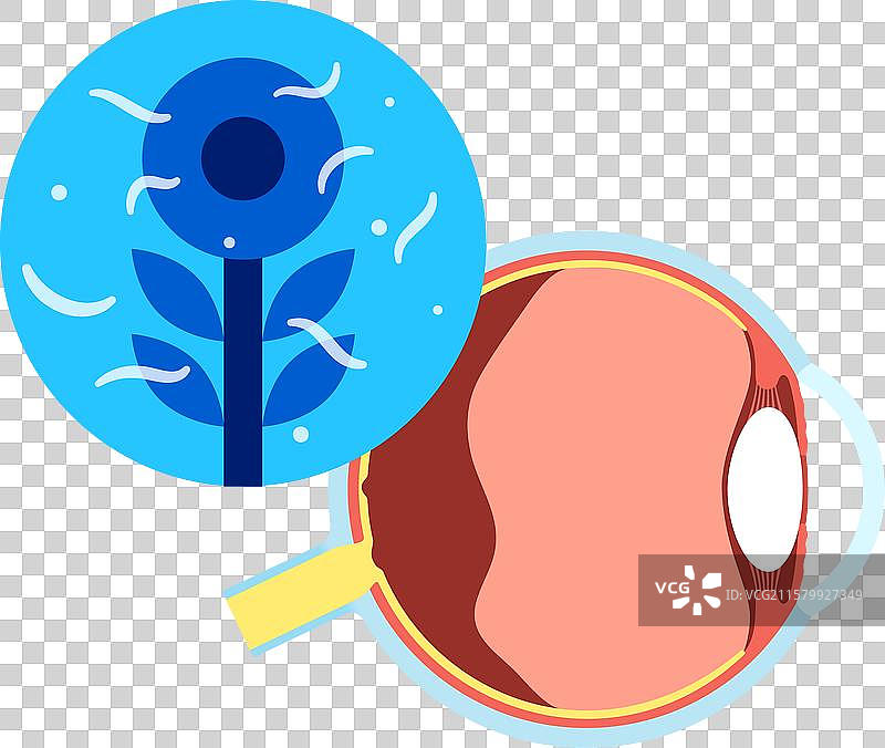 眼睛漂浮物症图片素材