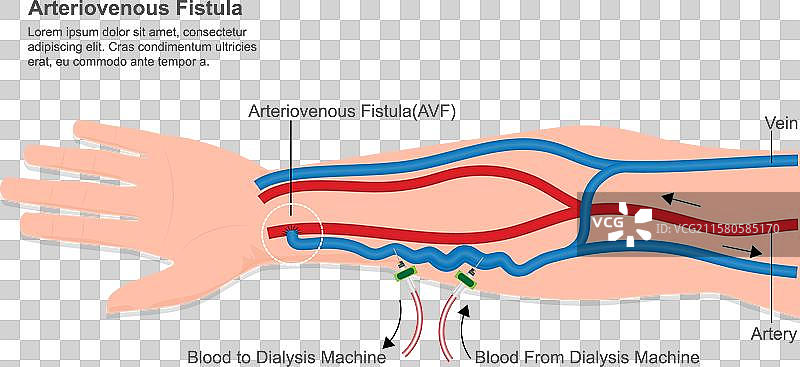 动静脉瘘是一种外科手术图片素材