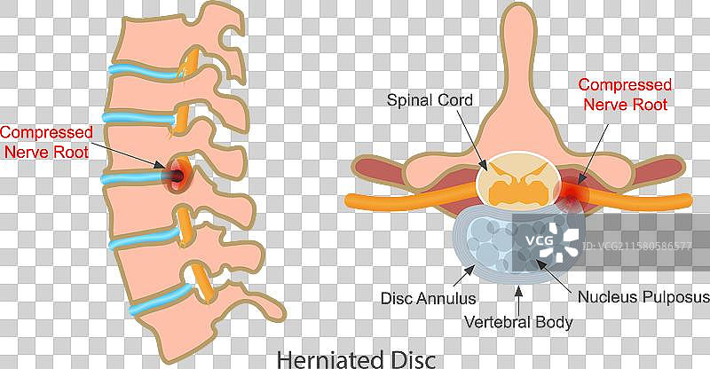 椎间盘突出是一种可能发生的病症。图片素材