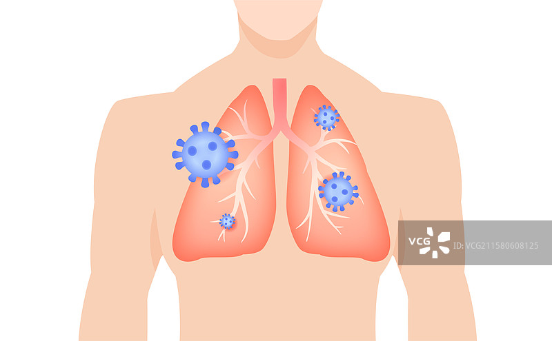 肺炎感冒流感肺气肿纤维化毒性流感图片素材