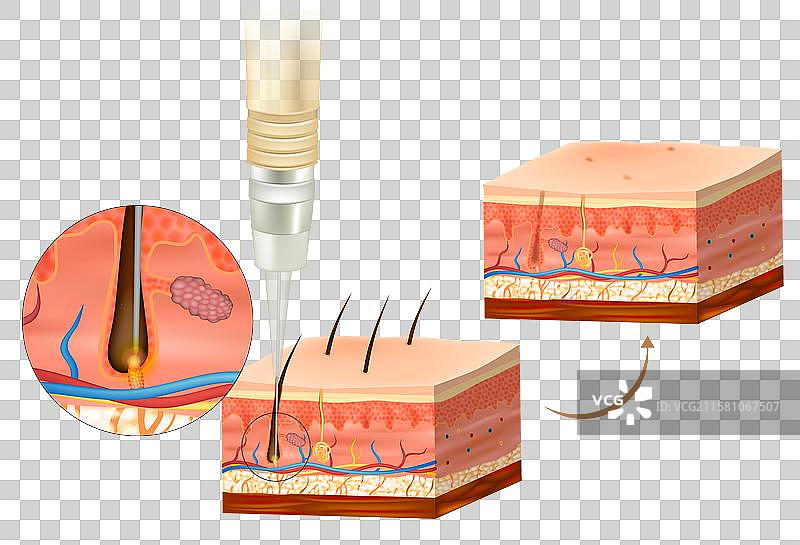 电解脱毛烧灼毛发根部图片素材