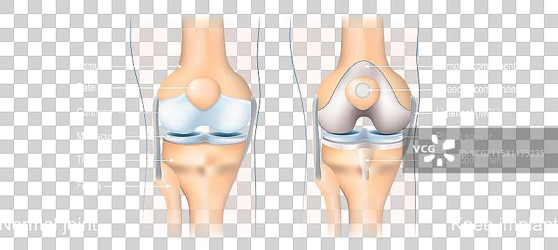 全膝关节置换术图片素材