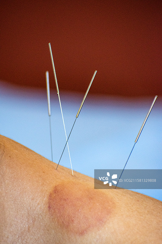 针灸、中医、肩周炎治疗、针灸扎针过程、治疗图片素材