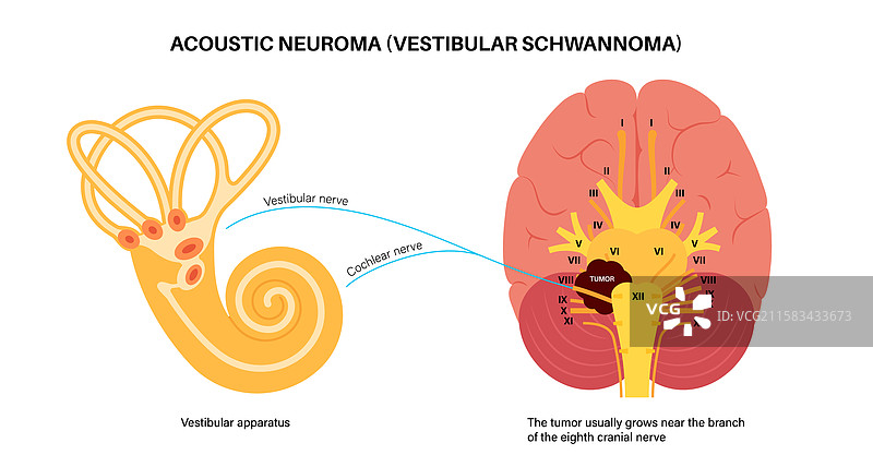 听神经瘤海报图片素材