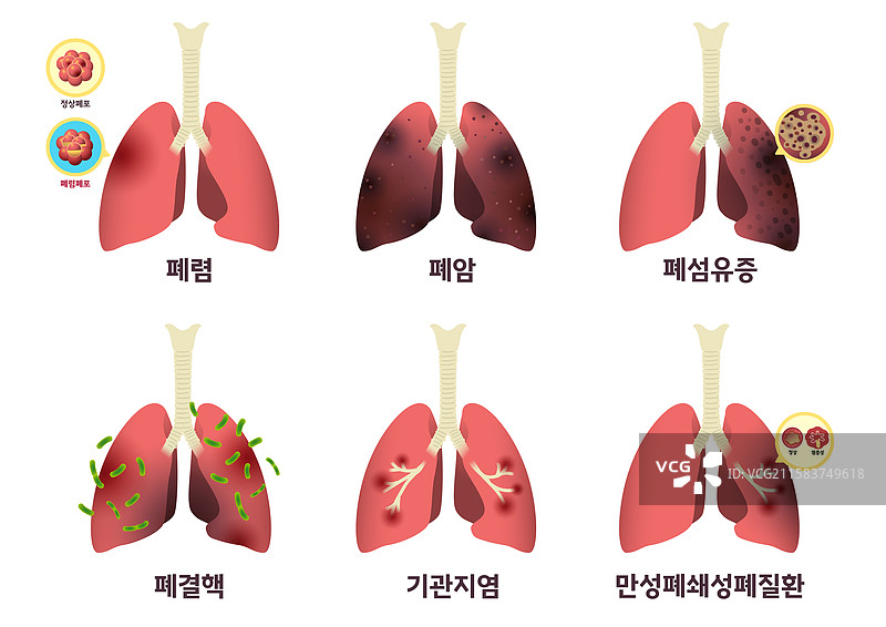 医学，医院，内脏，肺，肺炎，肺癌，结核病，支气管炎图片素材