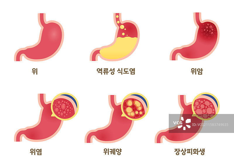 人体内部器官，消化器官，胃 [消化器官]，胃食管反流病，胃癌，胃炎，胃溃疡，肠化生图片素材